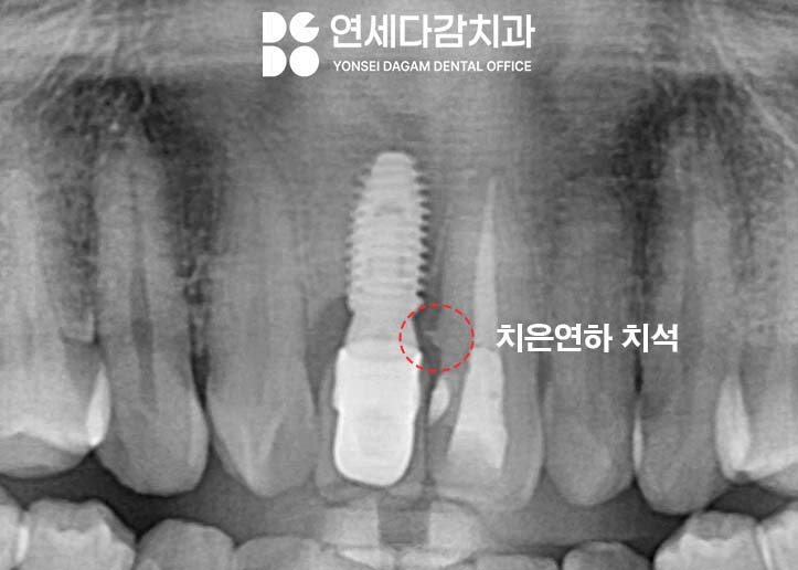 앞니 벌어짐 거여동 치과 치은성형술 동반하여 교정 없이 크라운 교체 및 최소삭제 라미네이트 통한 심미 치료 관련 이미지 4