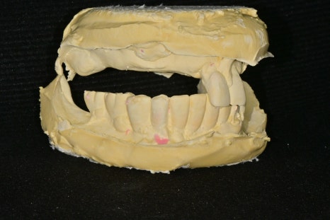 Songpa Station Dentist: Have You Been Using Dentures for a Long Time? <Digital Guided Implants> image 4