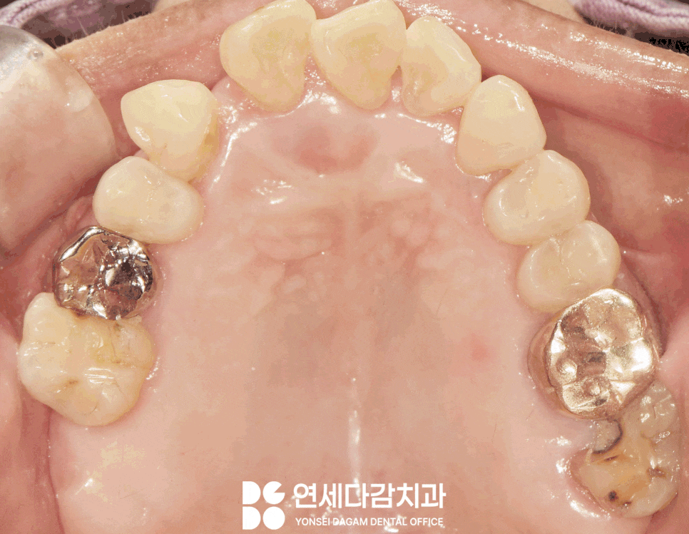 임플란트 재수술 가락동 치과 정밀한 분석과 전략적 접근 통한 치유 과정 관련 이미지 9