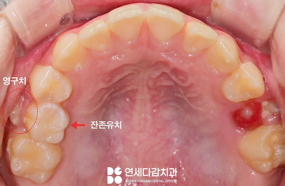 우리 아이 치아 성장 과정 가락시장역 치과 에서 알려주는 소아 유치 빠지는 순서 영구치 나는 시기 관련 이미지 3