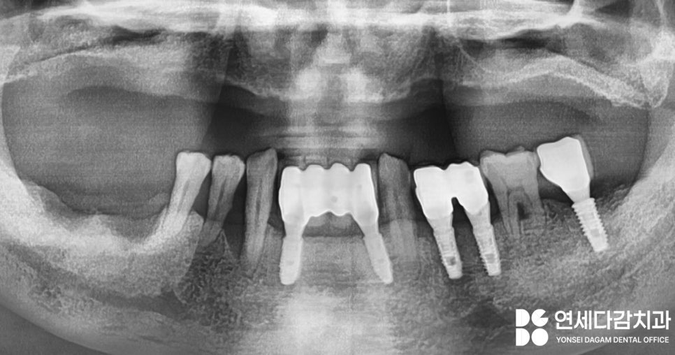 불편한 틀니 임플란트로 바꿔 치료할 수 있을지 가락시장역 치과 에서 살펴봅시다. 관련 이미지 1
