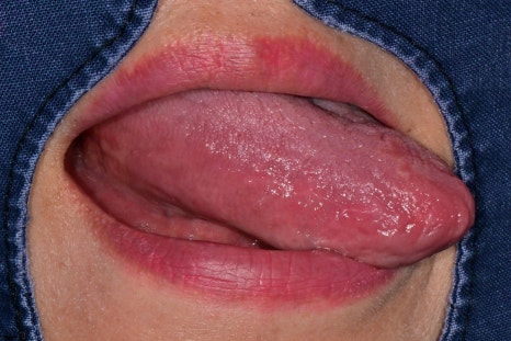 송파역 치과, 혀 갈라짐&middot;혀 지도설 원인과 치료 방법은? 관련 이미지 3