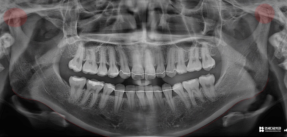 입 벌릴 때 불편하다면? 이갈이로 인한 통증 턱관절 증상 보톡스가 필요한 이유 가락동 치과 관련 이미지 3