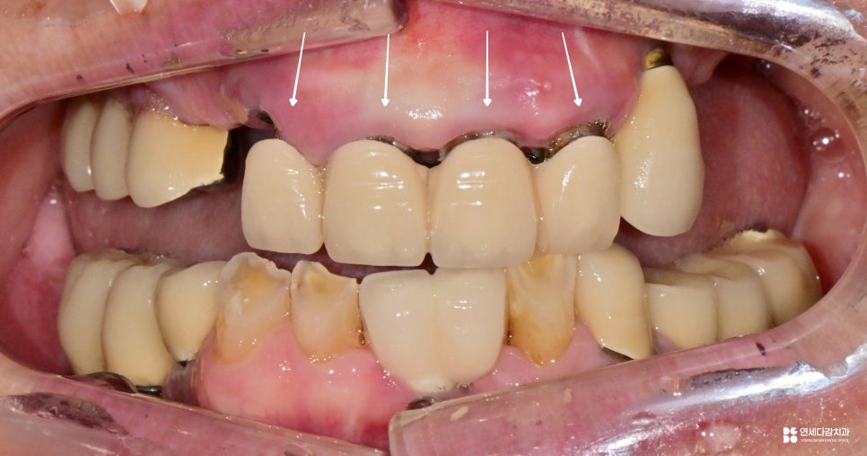 문정동 치과 수면마취(의식하진정법)으로 진행되는 임플란트 수술 관련 이미지 1