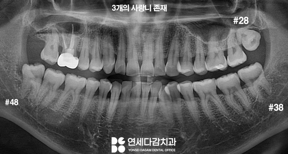 상악동 또는 신경 가까운 누워있는 매복 사랑니 가락시장역 치과 단순 발치를 위한 필수 CT 분석 과정 관련 이미지 1