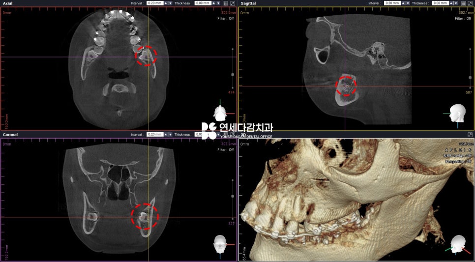 교정 중 사랑니 발치 진단 오금동 치과 에서 설측 수평 매복 발치 과정 알려드리겠습니다. 관련 이미지 4