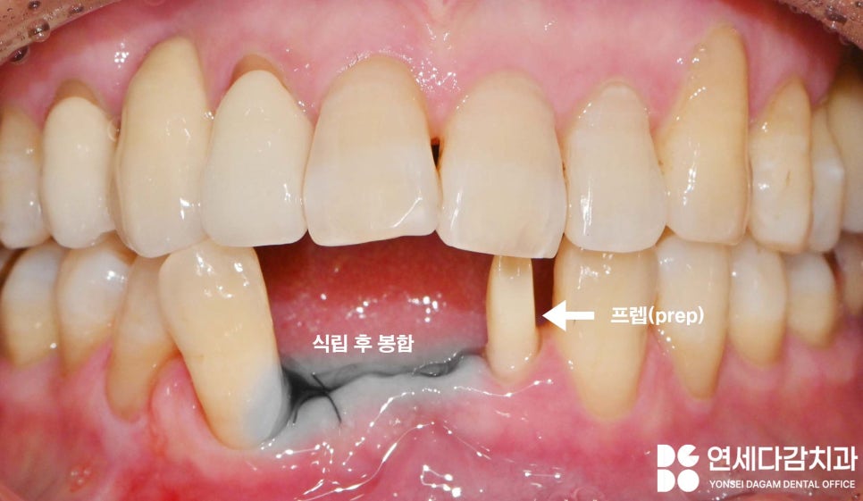 유독 까다로운 수술 부위가 있다? 오금역 치과 브릿지에서 임플란트 전환 과정 관련 이미지 5