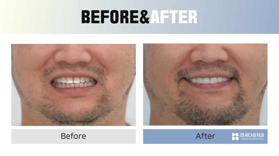 Ogeum-dong Dentist: Want to Improve Front-Tooth Discoloration and Black Triangles at Once with Veneers? <Must-Read> image 7