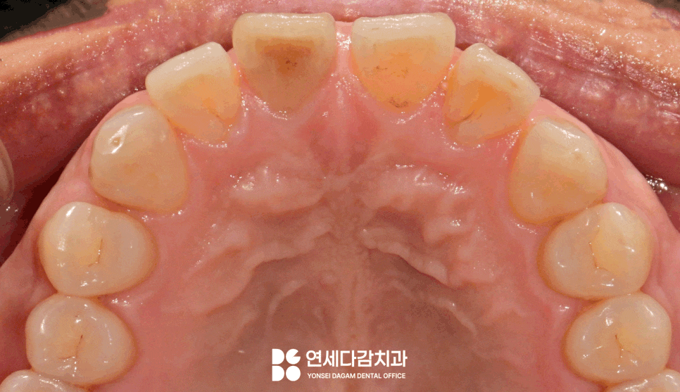 송파동 치과 앞니 사이 벌어짐 라미네이트 부분적으로 가능할까? 관련 이미지 3