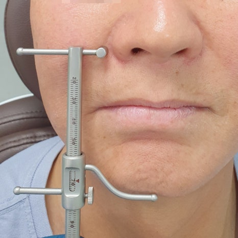 Munjeong-dong Full-Mouth Dental Implants: Why Did the Patient’s Appearance Change After Simply Replacing the Teeth? image 6