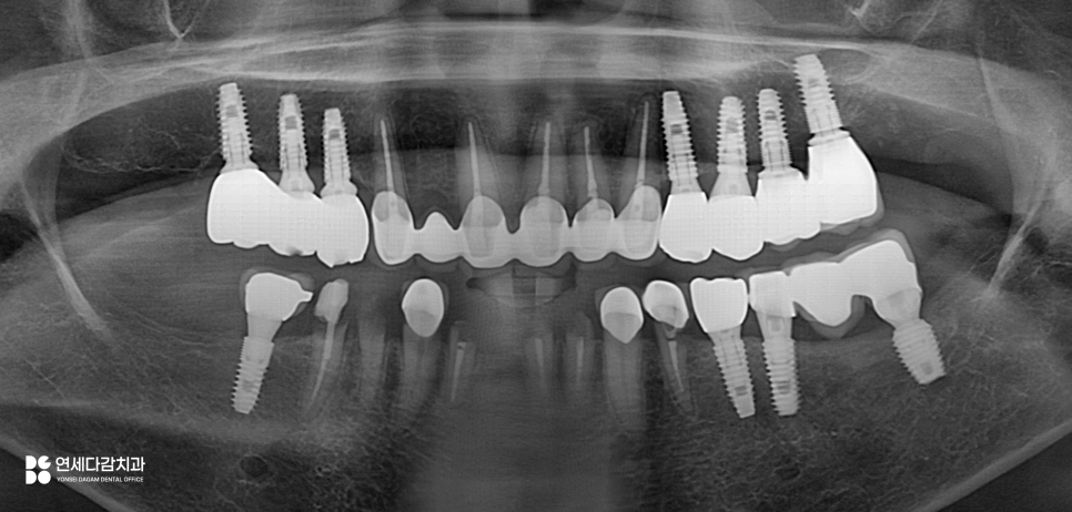 오금역 치과 부분틀니, 예후를 고려한 지대치 평가부터 정밀한 설계까지 중요한 이유 관련 이미지 3