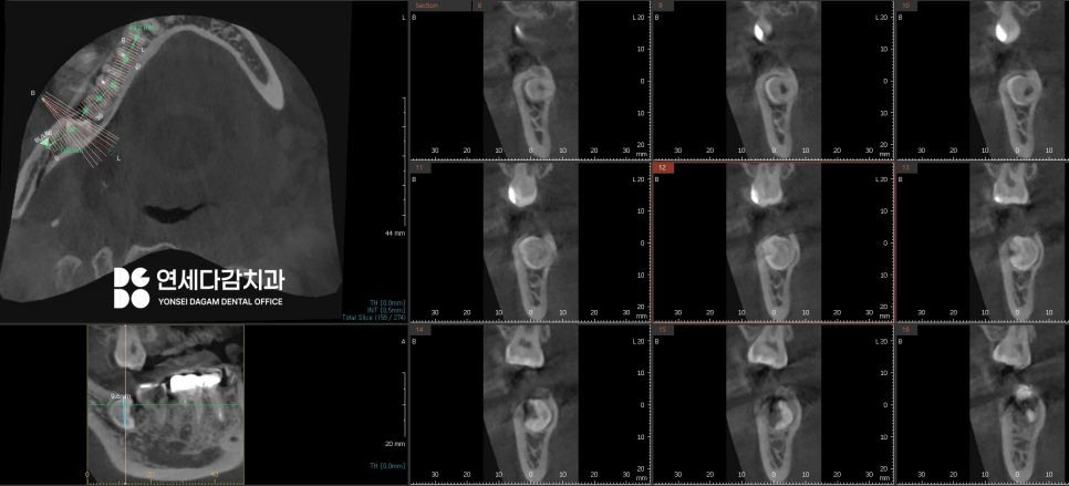 복잡한 매복 사랑니 발치 오금동 치과 에서 CT 촬영을 통한 분석 과정 관련 이미지 7