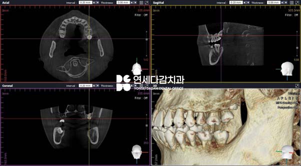 매복 사랑니 발치 시 관련 이미지 3