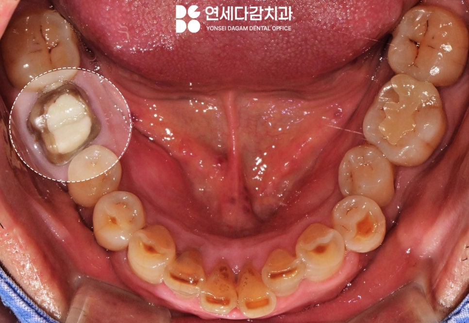 신경치료 후 크라운 떨어짐 원인으로 감염된 충치 치료 미루다 잇몸뼈 녹음 증상 개롱역 치과 발치 후 치근단 낭 적출술 관련 이미지 3
