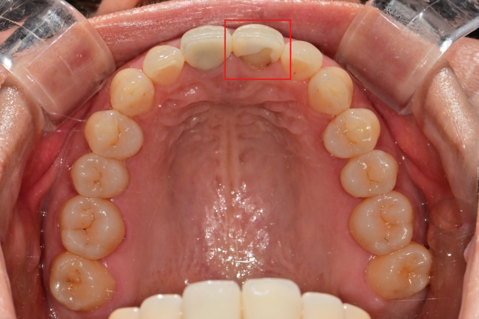 Songpa-dong Dentist: It Wasn’t Just the Front Crown That Was Replaced! A retreatment case that also considered the gum line image 2
