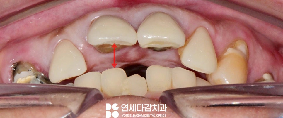 치주염 원인으로 치아 흔들림 오금동 치과 크라운 치료 통해 뻐드러진 앞니 돌출입 해소 과정에서 잇몸치료 필요한 이유 관련 이미지 6