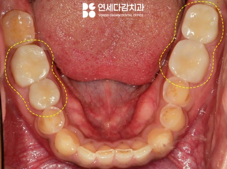 마모로 인한 치아 교모증 문정동 치과 에서 원인과 크라운 치료 방법 알려드리겠습니다. 관련 이미지 10