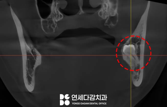 사랑니 부위 잇몸이 붓고 음식물이 자주 껴요 가락동 치과 매복사랑니 발치 후 지혈제 꼭 써야 좋을까? 관련 이미지 3