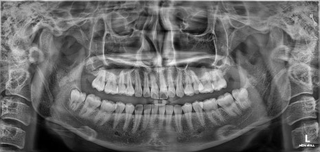 Garak-dong Wisdom Tooth Extraction: What If Two Wisdom Teeth Grew Fused Together? [A Case of Fused Wisdom Tooth Extraction] image 2