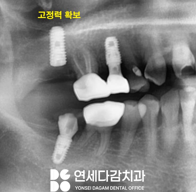 임플란트 재수술 가락동 치과 정밀한 분석과 전략적 접근 통한 치유 과정 관련 이미지 7