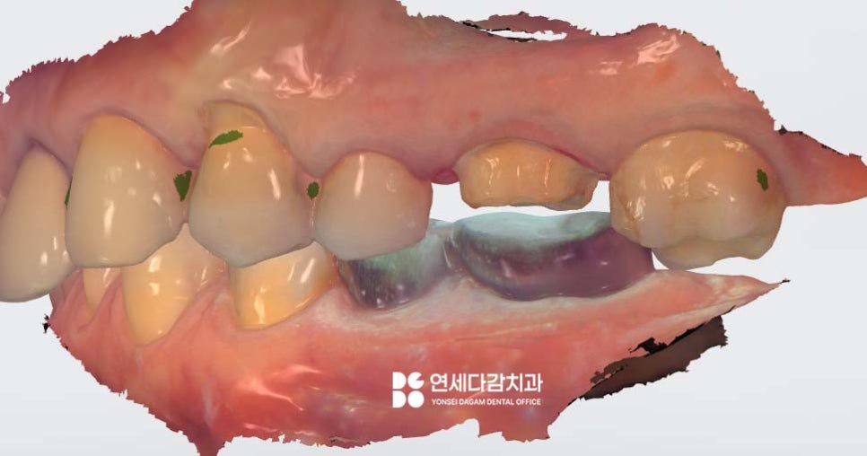 크라운 빠졌을 때 다시 붙일 수 있을까 문정동 치과 구강 스캐너 통한 보철 제작 관련 이미지 5