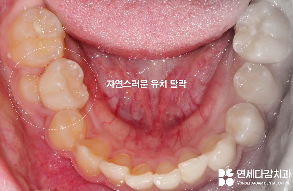 우리 아이 치아 성장 과정 가락시장역 치과 에서 알려주는 소아 유치 빠지는 순서 영구치 나는 시기 관련 이미지 2