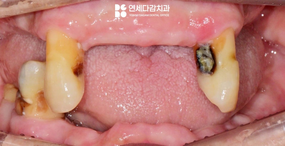 항암 치료 전 발치 필요할 때 기존 부분틀니 송파동 치과 에서 보철 수정 후 임시로 완전틀니 만든 이유 관련 이미지 3