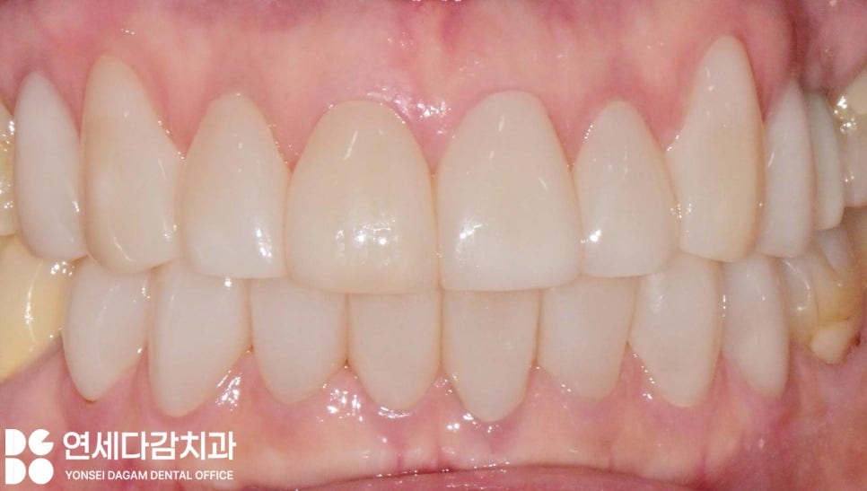 누런이 미백 안 해도 하얀이 원할 때 송파동 치과 최소삭제 라미네이트 과정에서 잇몸 치은 성형술 필요한 이유 관련 이미지 8