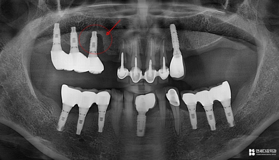문정동 치과 수면마취(의식하진정법)으로 진행되는 임플란트 수술 관련 이미지 2