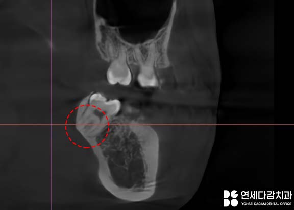 거여동 치과 매복 사랑니 발치 후 치아 뿌리 조각 부러짐 잔존치근 일부러 남겨두는 이유 관련 이미지 4
