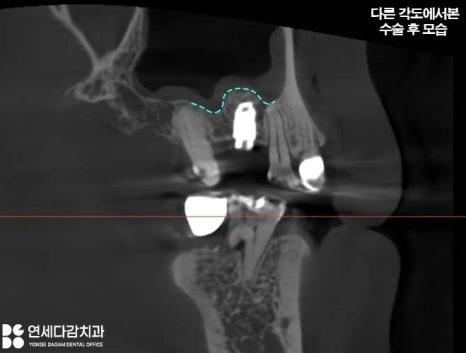 잇몸뼈 없으면 임플란트 수술 못할까? 오금역 연세다감 치과 상악동 거상술 뼈이식 필요한 경우 관련 이미지 5