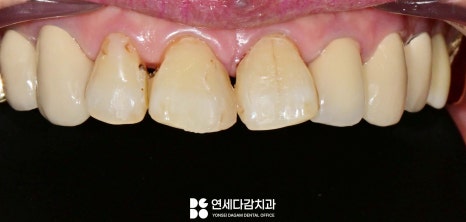 앞니 레진 후 생긴 변색 문제와 삐뚤어진 치아 개롱역 치과 최소삭제 라미네이트 적용할 수 있는 이유 관련 이미지 5