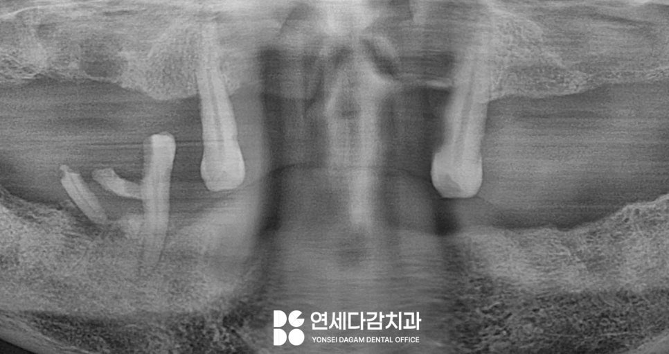 항암 치료 전 발치 필요할 때 기존 부분틀니 송파동 치과 에서 보철 수정 후 임시로 완전틀니 만든 이유 관련 이미지 1