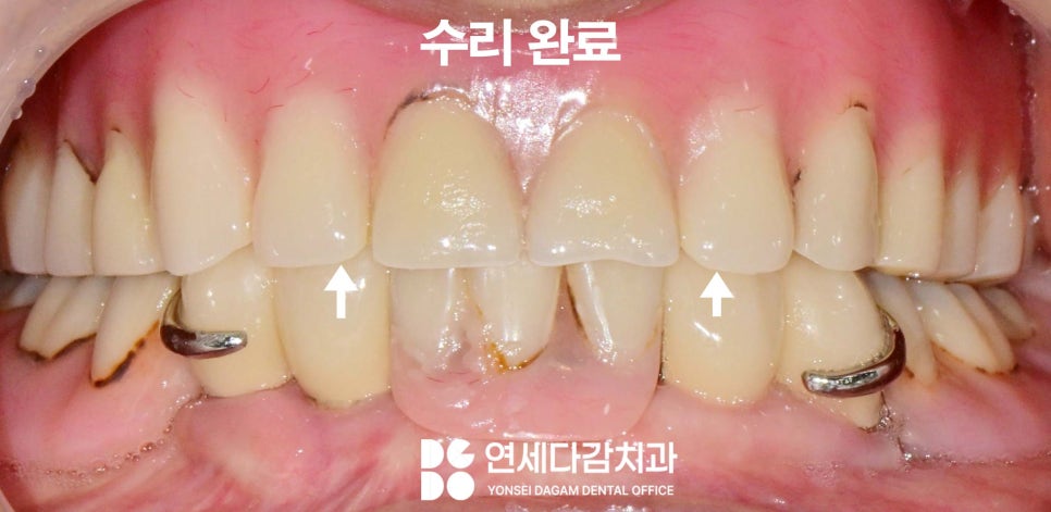 거여동 치과 임플란트 틀니 깨졌을 때 오버덴처 overdenture 종류 및 수리 기간 관련 이미지 7