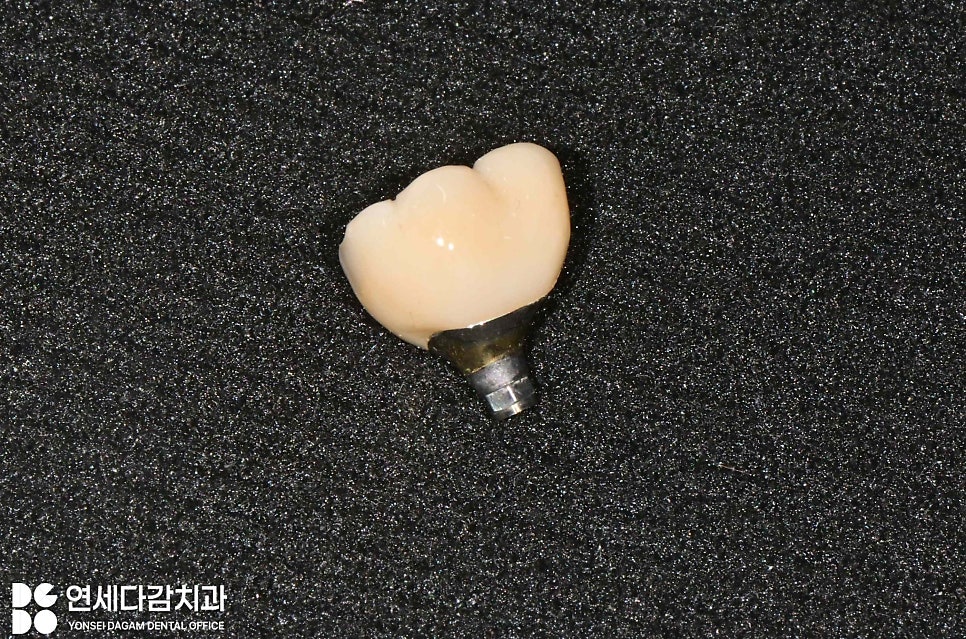 임플란트 빠짐 또는 흔들림 거여역 치과 나사 부러지고 빠졌을 때 재수술 없이 보철 크라운 교체할 수 있는 방법 관련 이미지 3