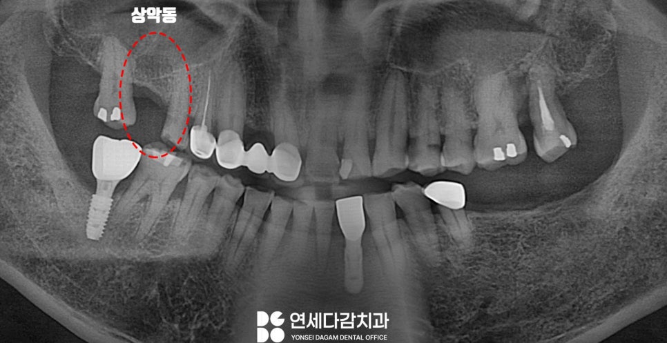 잇몸뼈 없으면 임플란트 수술 못할까? 오금역 연세다감 치과 상악동 거상술 뼈이식 필요한 경우 관련 이미지 2
