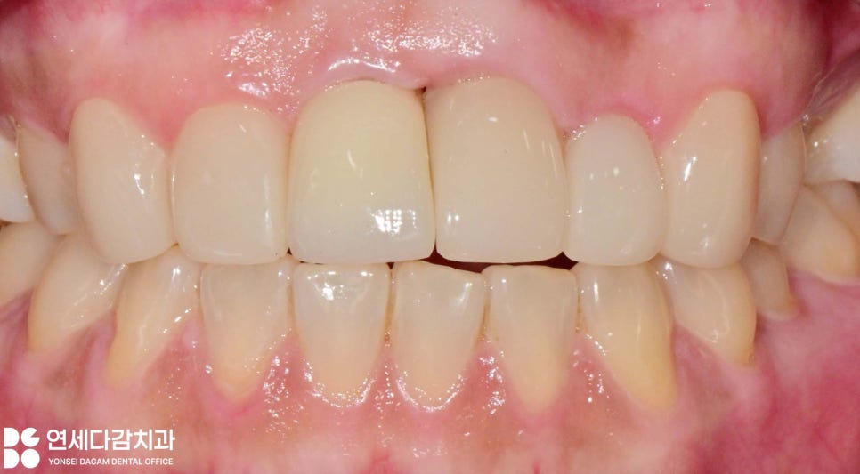 앞니 벌어짐 거여동 치과 치은성형술 동반하여 교정 없이 크라운 교체 및 최소삭제 라미네이트 통한 심미 치료 관련 이미지 9