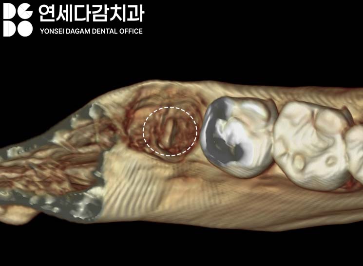If the gums keep swelling and pus keeps coming out after impacted wisdom tooth extraction, how to find tooth root fragments remaining in the jawbone at a dental clinic in Songpa District image 3
