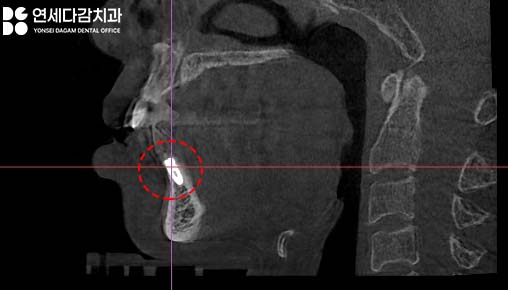 유독 까다로운 수술 부위가 있다? 오금역 치과 브릿지에서 임플란트 전환 과정 관련 이미지 3