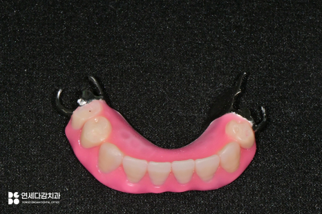 오금역 치과 부분틀니, 예후를 고려한 지대치 평가부터 정밀한 설계까지 중요한 이유 관련 이미지 8