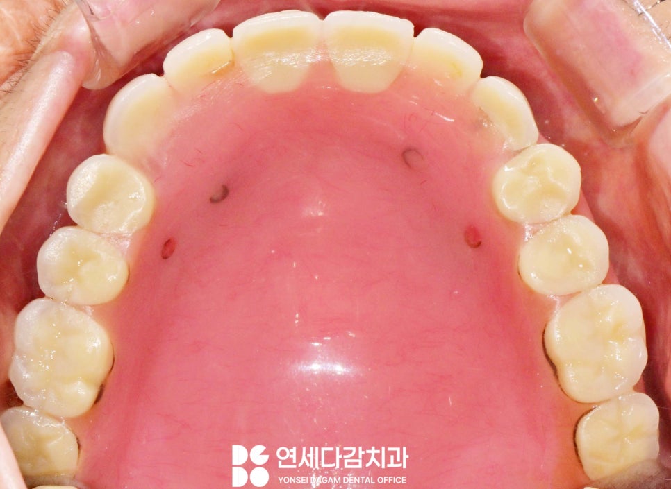 거여동 치과 임플란트 틀니 깨졌을 때 오버덴처 overdenture 종류 및 수리 기간 관련 이미지 8