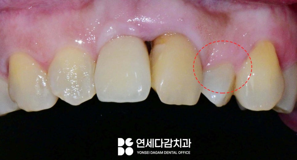 앞니 벌어짐 거여동 치과 치은성형술 동반하여 교정 없이 크라운 교체 및 최소삭제 라미네이트 통한 심미 치료 관련 이미지 2