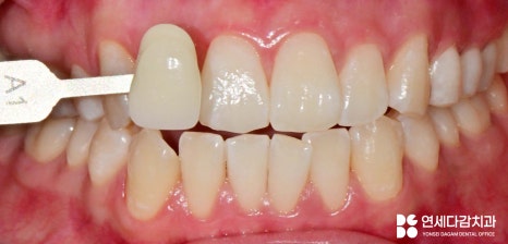 거여동 치과 전문가 치아 미백 원리와 올바른 관리 방법 알아봅시다. 관련 이미지 5