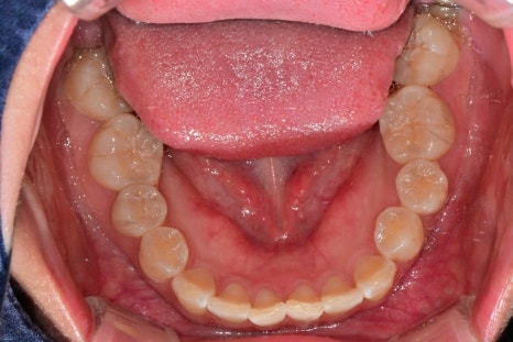 Garak-dong Wisdom Tooth Extraction: What If Two Wisdom Teeth Grew Fused Together? [A Case of Fused Wisdom Tooth Extraction] image 3