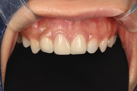 Macheon-dong Dental Clinic: Why Treating Root Inflammation Comes First Before an Anterior Crown image 6