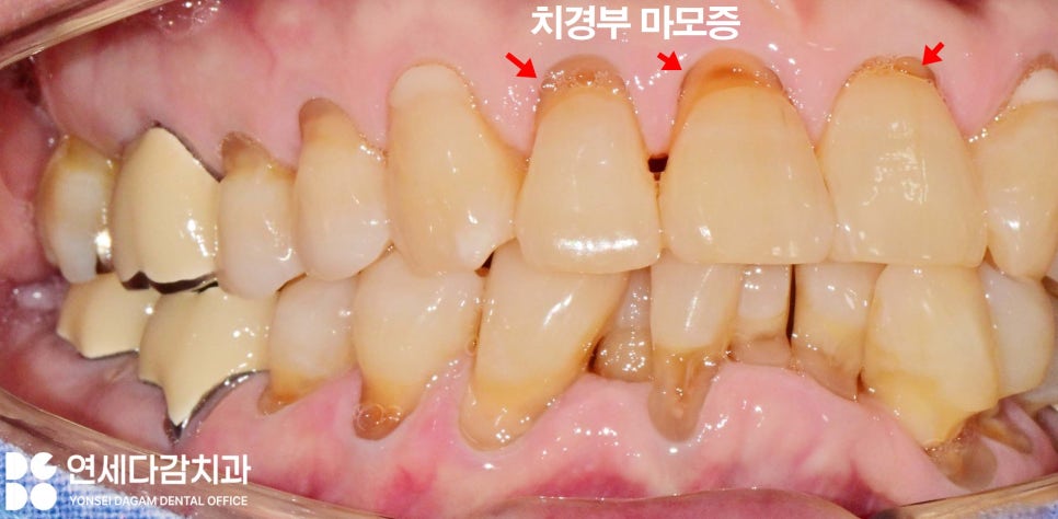 치아 이시림 왜 더 심해질까 개롱역 치과 치경부 마모증 원인과 레진 충전 및 글래스아이오노머(GI) 치료 특징 비교 관련 이미지 2