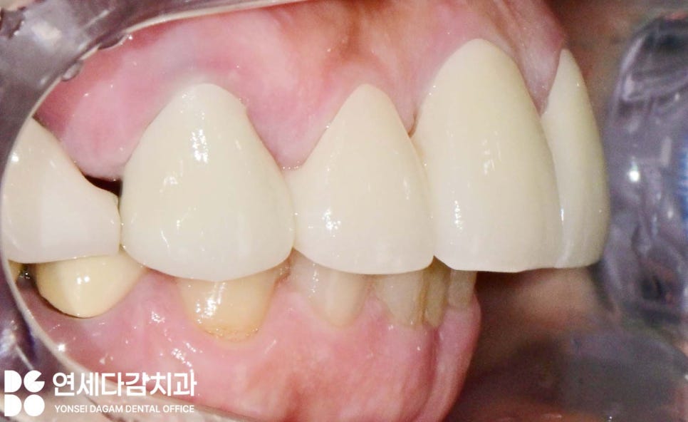 치주염 원인으로 치아 흔들림 오금동 치과 크라운 치료 통해 뻐드러진 앞니 돌출입 해소 과정에서 잇몸치료 필요한 이유 관련 이미지 5