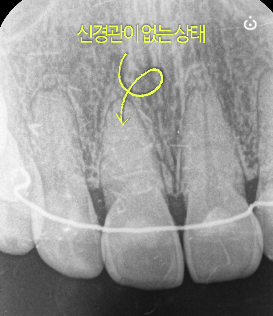 Geoyeo-dong Dental Clinic: Case of Internal Bleaching for a Discolored Front Tooth After Trauma image 3