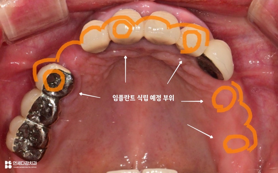 문정동 치과 수면마취(의식하진정법)으로 진행되는 임플란트 수술 관련 이미지 3
