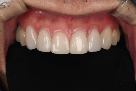 Ogeum-dong Dentist: Want to Improve Front-Tooth Discoloration and Black Triangles at Once with Veneers? <Must-Read> image 6